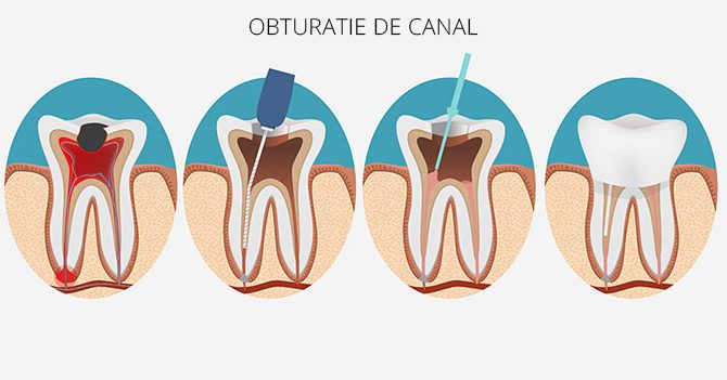 OBTURATIE DE CANAL